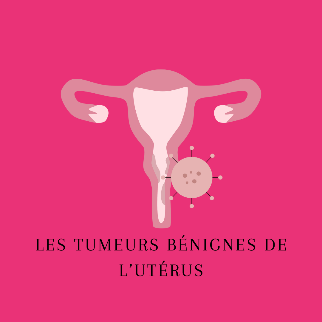 Les tumeurs bénignes de l’utérus