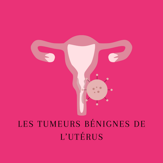 Les tumeurs bénignes de l’utérus